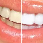 Come sbiancare i denti: rivolgersi ad un dentista.